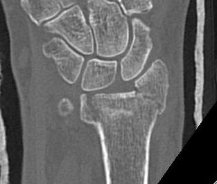 Distal Radius Fracture Articular Step Coronal CT